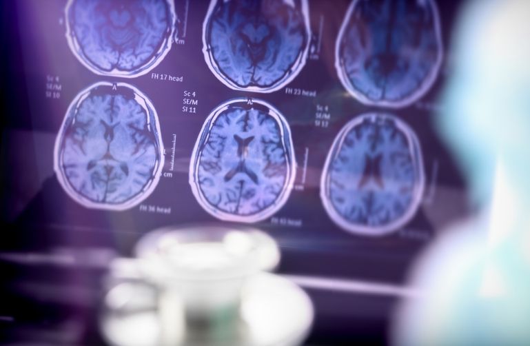 Imagen representativa de las enfermedades neurodegenerativas, mostrando el cerebro humano y su relación con la neuropsicología en el tratamiento y diagnóstico de trastornos cerebrales